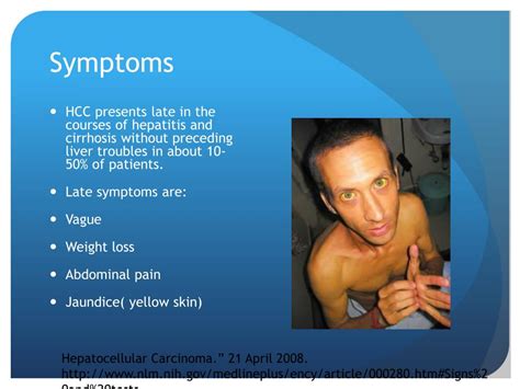 PPT - Hepatocellular carcinoma PowerPoint Presentation, free download - ID:2821852