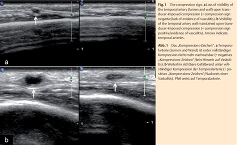 Figure 1 from Temporal artery compression sign--a novel ultrasound ...