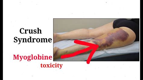 Crush syndrome ! rhabdomyolysis ! Muscles injury(Hindi) - YouTube