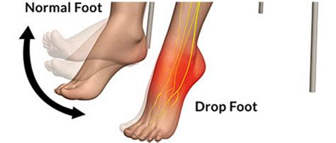 Foot Drop Causes, Symptoms | Homeopathic Treatment