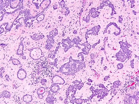 Epithelioid Mesothelioma Pathology Outlines - Goimages 411