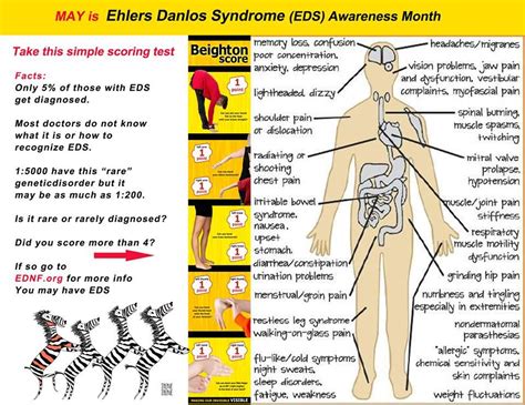 Ehlers Danlos Syndrome Types | Diy Furniture Ideas