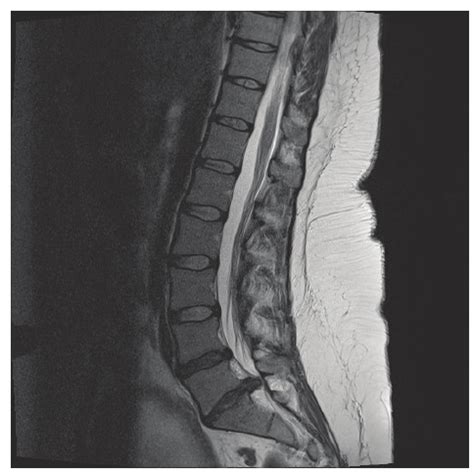 MRI Lumbar Spine L5 S1