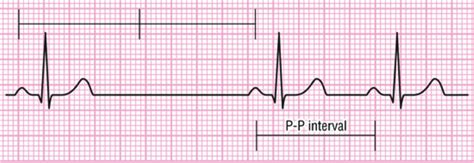 ECG 7.2 Ritmo sinusal, arritmias del nodo sinusal - Cardio Science