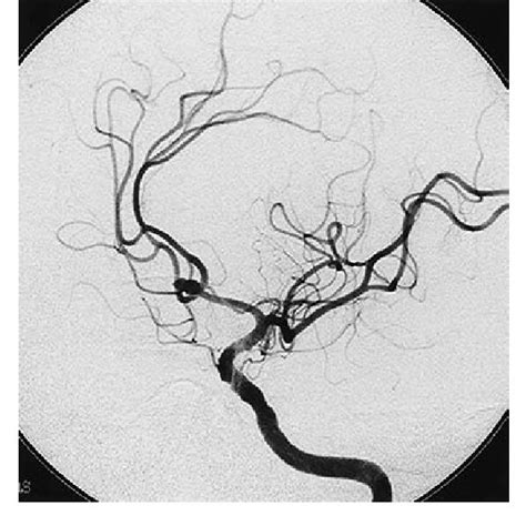 Preoperative left internal carotid angiogram (left oblique projection ...