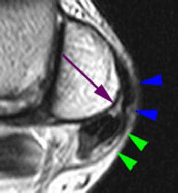 Peroneal Tendon Dislocation and Superior Peroneal Retinaculum Injury ...