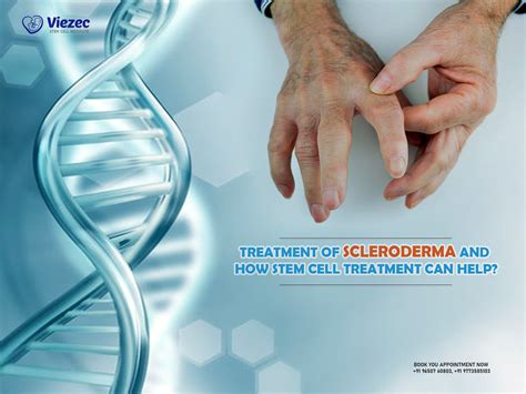 Treatment of Scleroderma and How Stem Cell Treatment Can Help