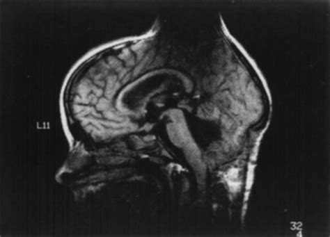 Magnetic Resonance Imaging Artifacts | Radiology Key