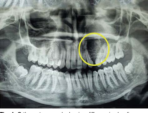 Figure 4 from Odontogenic Myxoma of Maxilla | Semantic Scholar