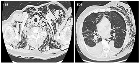 Medicina | Free Full-Text | A Case of Pneumothorax Ex Vacuo Associated ...