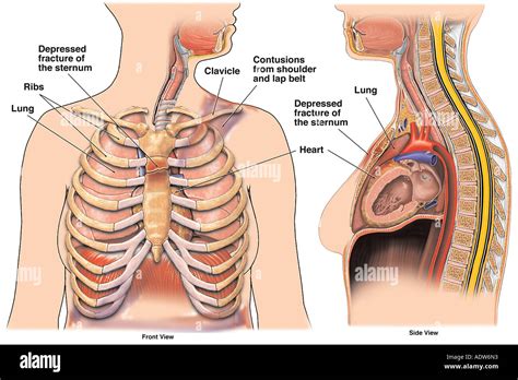 Broken Sternum X Ray