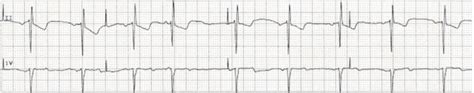 emDOCs.net – Emergency Medicine EducationEM@3AM: Pacemaker/AICD Complications - emDOCs.net ...