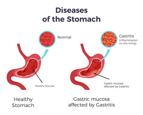 Here is everything you need to know about gastritis. - Yashoda Hospital