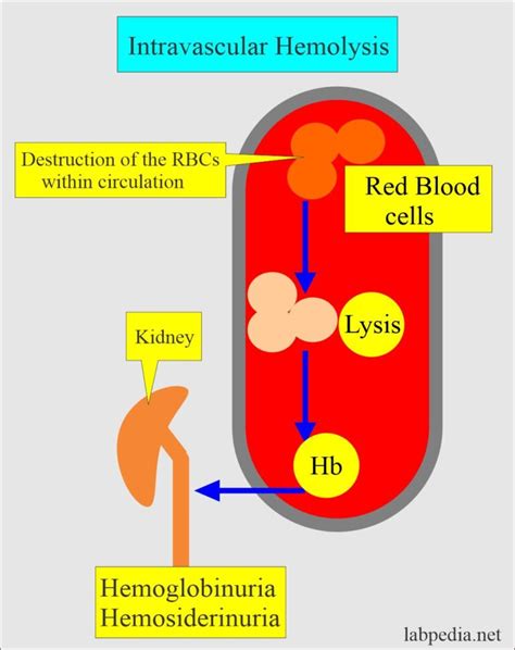 Anemia:- Part 8 - Hemolytic Anemias Classification, Autoimmune ...