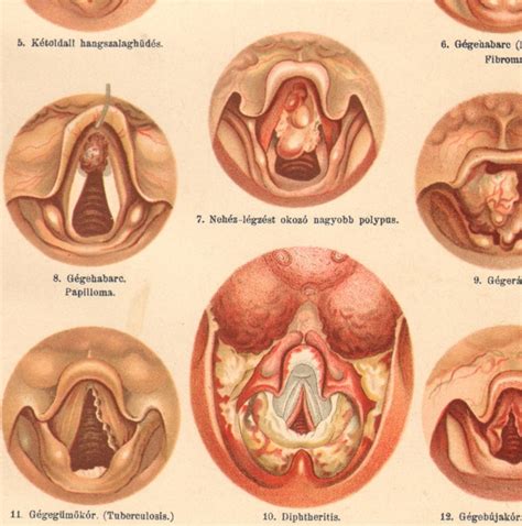 1894 Diseases of the Larynx Croup Nodules Polyps | Etsy