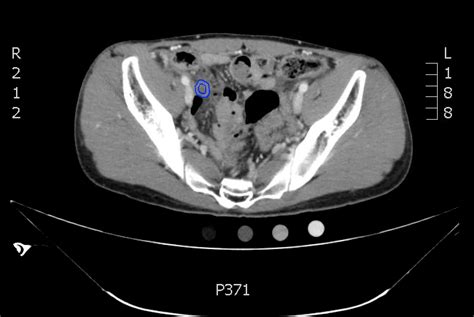 Appendicitis, CT Axial, Hyperenhancing Annotated. JETem 2017 - JETem