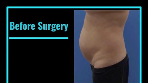 Liposuction 360! - YouTube