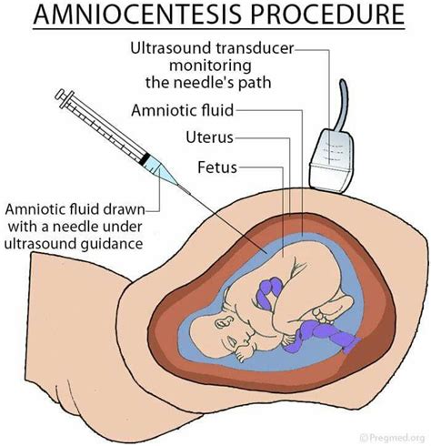 Amniocentesis procedure | Pediatric nurse practitioner, Newborn nursing ...