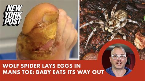 Wolf spider lays eggs in man’s toe, baby hatches inside: ‘Eating its ...