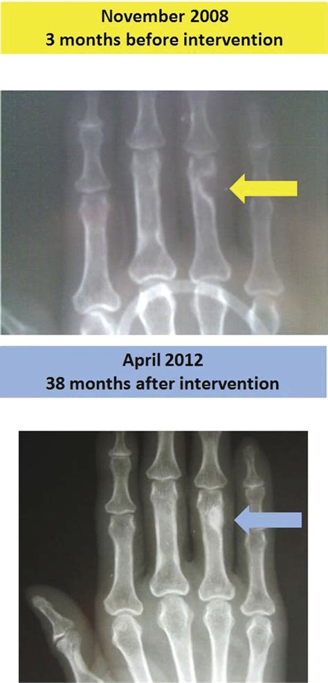 Osteitis Fibrosa Cystica Brown Tumor