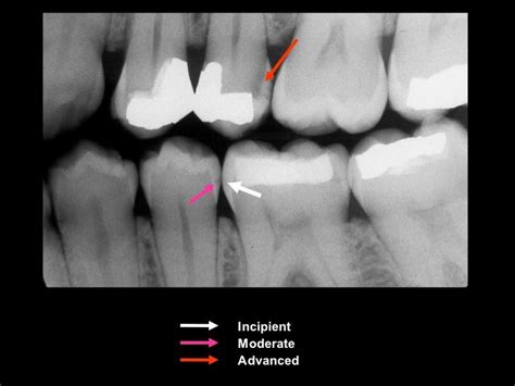 radiographic-caries-diagnosis