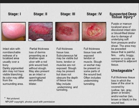 Nursing Cheat, Nursing Tips, Nursing Notes, Wounds Nursing, Wound Care ...