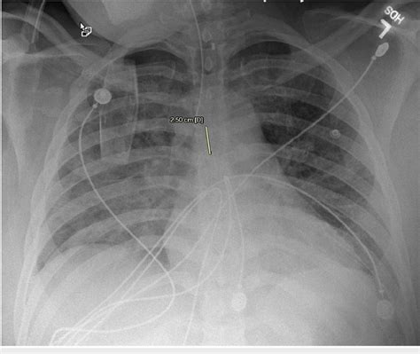 Post-intubation chest X-ray. | Download Scientific Diagram