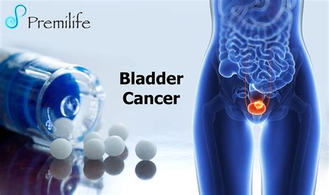 Bladder Cancer: Urinary Bladder Cancer Treatment