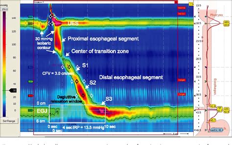 [PDF] Recent Concept in Interpreting High-Resolution Manometry | Semantic Scholar