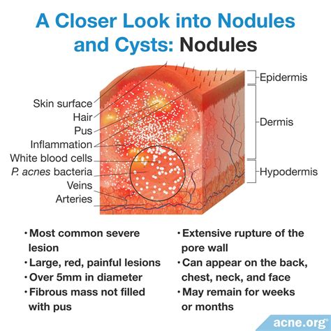 What Is Cystic Acne? - Acne.org