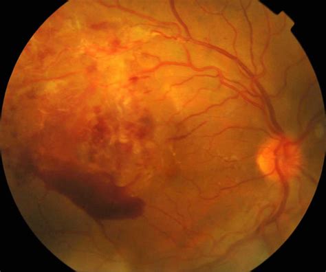 Retinal vasculitis causes, symptoms, diagnosis, treatment & prognosis