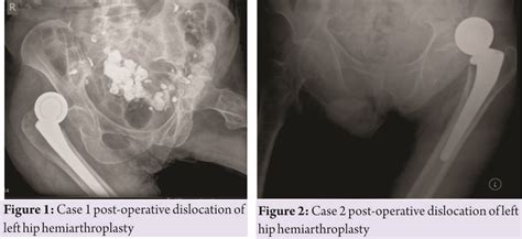 Hip Hemiarthroplasty in Neurologic or Cognitively Impaired Patients: A ...