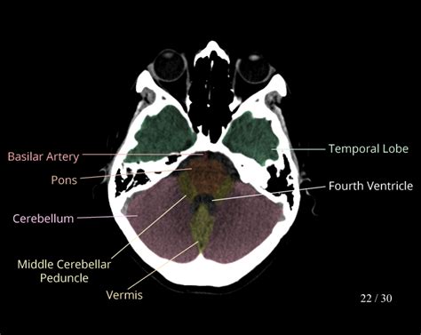 Normal Brain Ct Anatomy