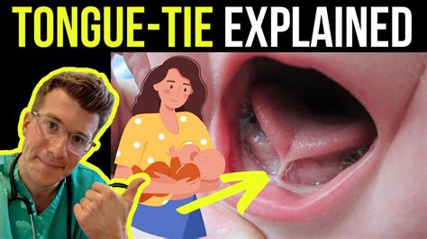 Doctor explains tongue tie in babies (ankyloglossia) - including treatment options! - YouTube