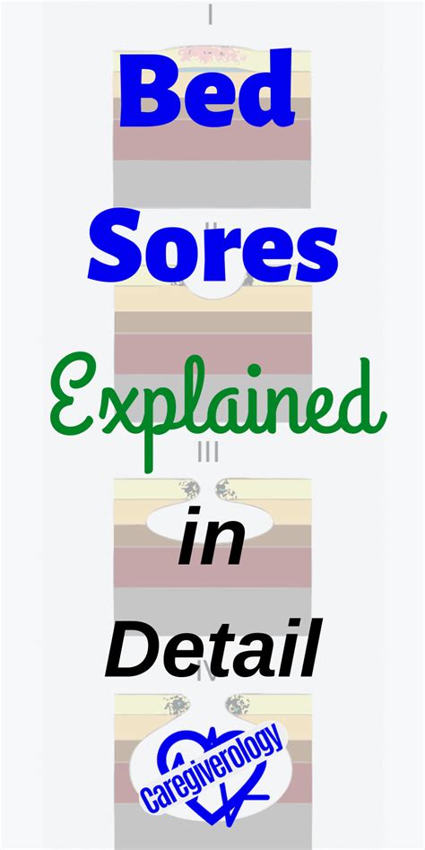 Bed Sores Explained in Detail - Caregiverology | Bed sores, Soreness ...