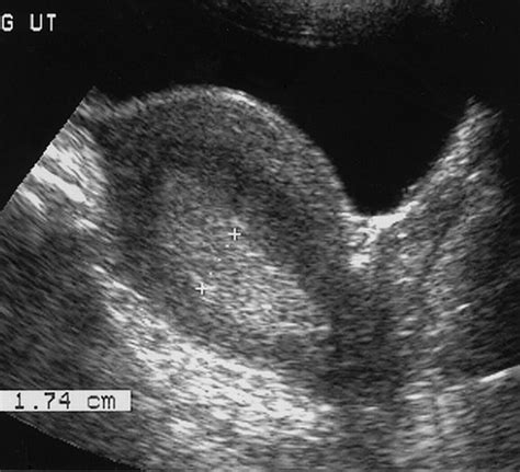 Imaging the Endometrium: Disease and Normal Variants | RadioGraphics