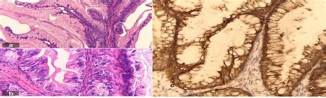 High power view of a mucinous borderline ovarian tumor that shows... | Download Scientific Diagram