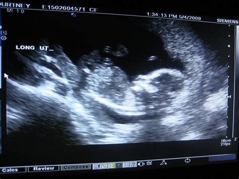 Pregnancy and Birth: 14 Weeks --- First Ultrasound