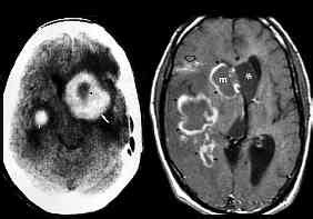 Mri Brain: Mri Brain Lymphoma