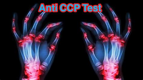 What does anti-CCP positive mean | What is anti-CCP normal range | Anti CCP Test - YouTube