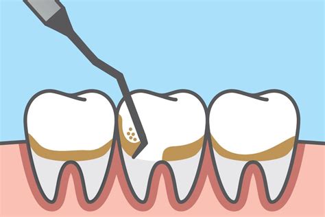 Scaling and Root Planing - Denver, CO - Dr. Kyle Long