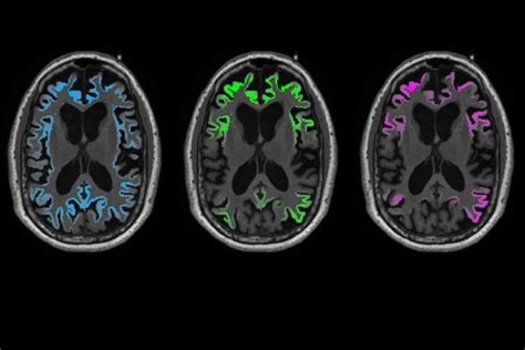 Alzheimer ‘Tau’ Protein Far Surpasses Amyloid in Predicting Toll on Brain Tissue | UC San Francisco