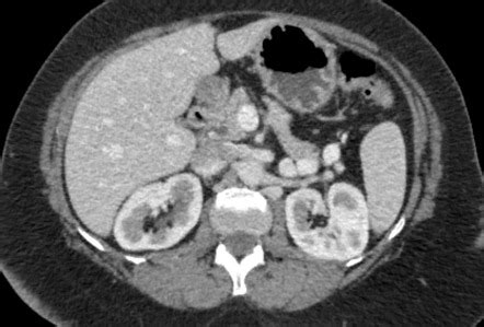 Insulinoma | Image | Radiopaedia.org