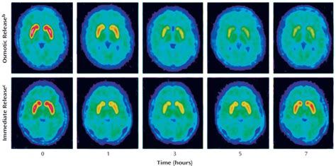 Serial PET Brain Images Showing Striatal Dopamine Transporter Receptor... | Download Scientific ...