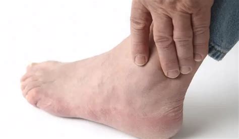 Causes of Ankle Pain and Swelling gouty arthritis