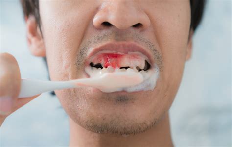 Bleeding Gums - Dental Conditions in San Diego | Dental Arts San Diego