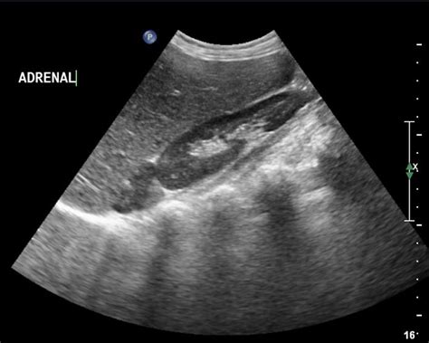 Ultrasound image showing enlarged hypoechoic adrenal gland. Pyramidal ...