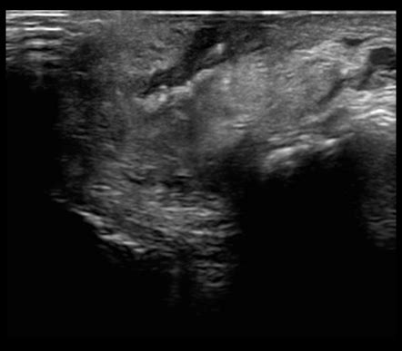 Suture granuloma | Radiology Case | Radiopaedia.org