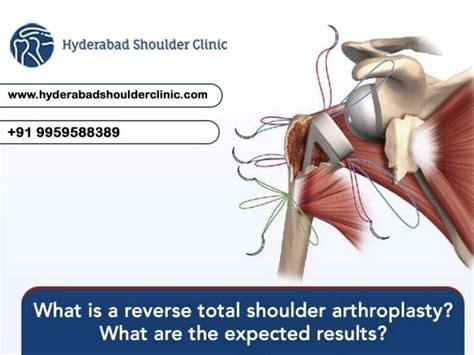 What is a reverse total shoulder arthroplasty? What are the expected results?