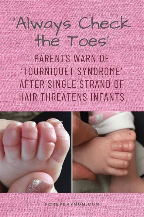 Hair tourniquet syndrome | For Every Mom